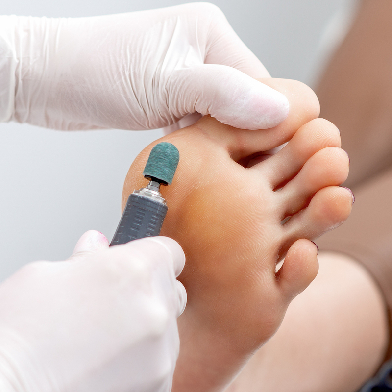 Peeling feet pedicure procedure on foot